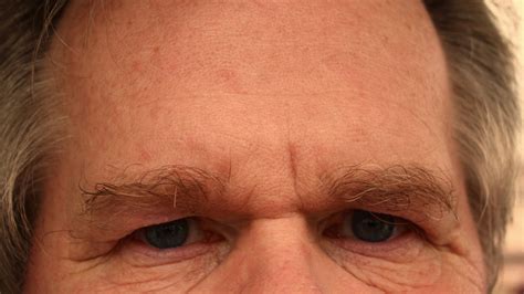 Deep Forehead Wrinkles Mark A Higher Risk Of Dying From Cardiovascular ...