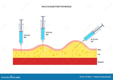 Insulin Injection Technique. Correct And Incorrect Way. Cross-section ...