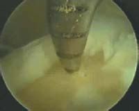 No complications reported using microfracture for talar cartilage