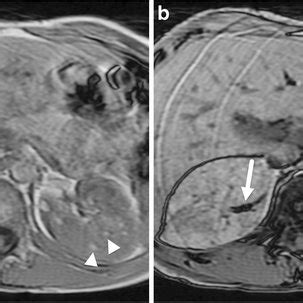 Tuberous sclerosis complex and a large adrenal angiomyolipoma (AML) in... | Download Scientific ...