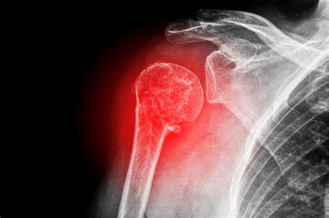 Shoulder Fracture: Facts, types, treatment, & management | FactDr