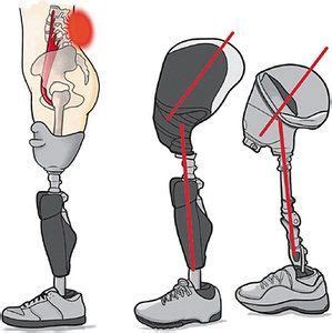 Hip Flexor Contractures & LBP in Above-the-Knee Amputations | Dynamic Chiropractic