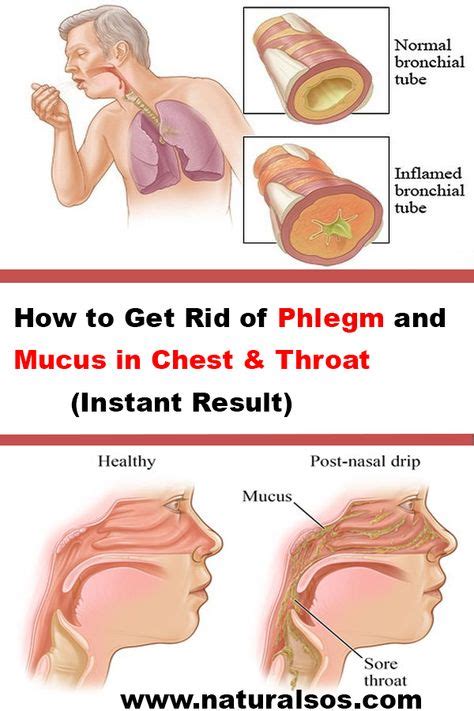 How to Get Rid of Phlegm and Mucus in Chest & Throat (Instant Result ...