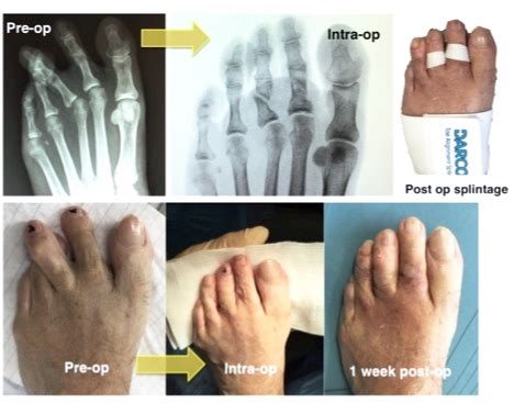 Minimally Invasive Lesser Toe Surgery | David Redfern Surgery