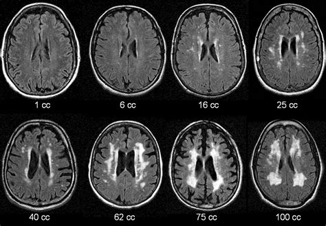 Altered Functional MR Imaging Language Activation in Elderly Individuals with Cerebral ...