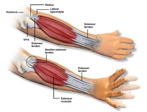 How Massage can provide relief from Wrist and Arm RSIs