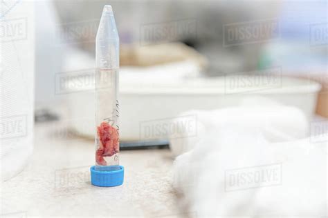 a tissue sample from the tumor to be sent for histological expertise. - Stock Photo - Dissolve