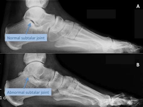 Subtalar Arthritis | Arthritis Of The Subtalar Joint | LFAC