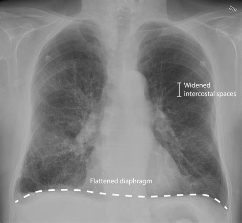 Chronic Obstructive Pulmonary Disease (COPD) | Concise Medical Knowledge