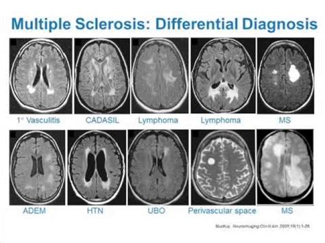 Ms Mri Brain Scan Results