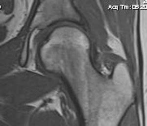 Hip Impingement Syndrome Mri