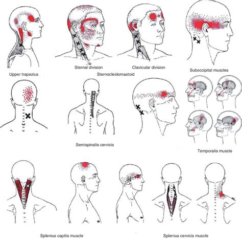 Pdf myofascial trigger points and sensitization an updated pain model ...