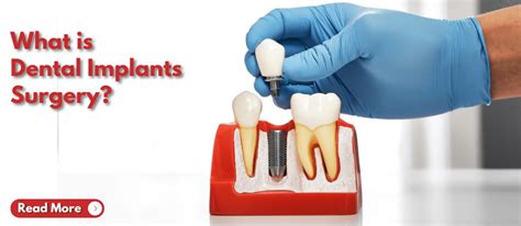 What is Dental Implants Surgery?