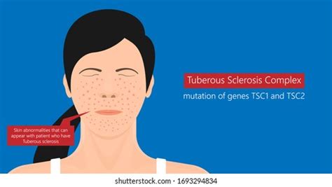 Tuberous Sclerosis Complex Genetic Disease Symptoms Stock Vector (Royalty Free) 1693294834 ...