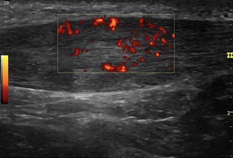 A standardizing method to assess tendon structural change on ultrasound