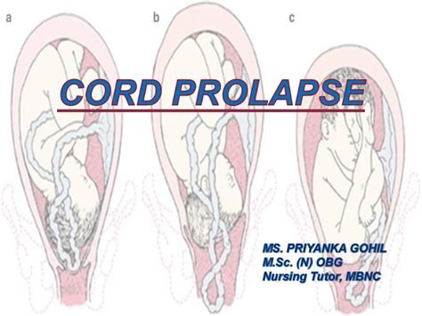 Cord prolapse