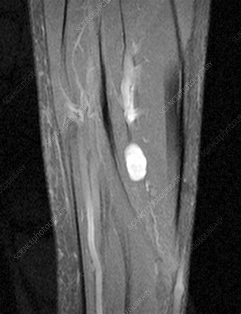 Schwannoma nerve sheath tumour, MRI - Stock Image - C030/0008 - Science Photo Library