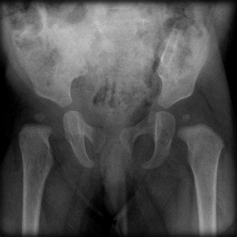 PELVIS-9 MONTHS OLD | Buyxraysonline