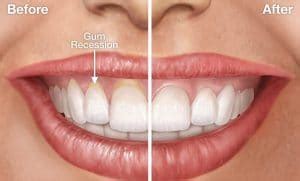 Gum Recession Symptoms And Treatment - Smile Team Turkey