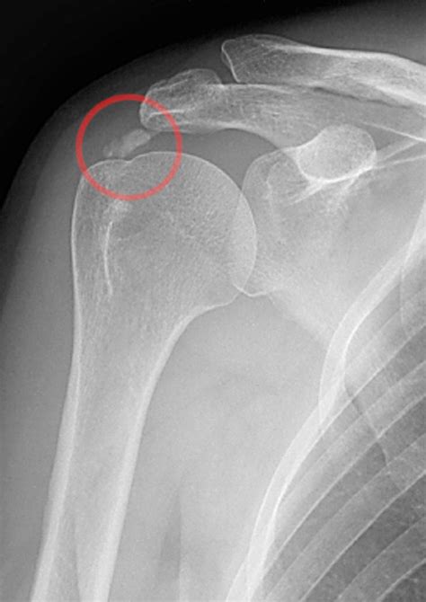 Calcific tendinitis - Wikipedia