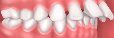 Reasons You Have Misaligned Teeth