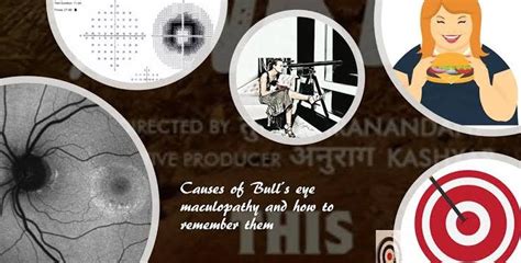 Bull's eye maculopathy: how to remember the causes (mnemonic) video ...