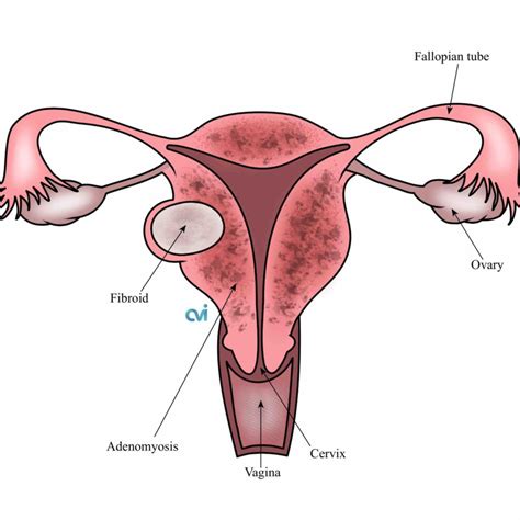 Adenomyosis Vs Endometriosis: Key Differences