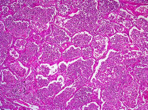 Lobar Pneumonia Histology