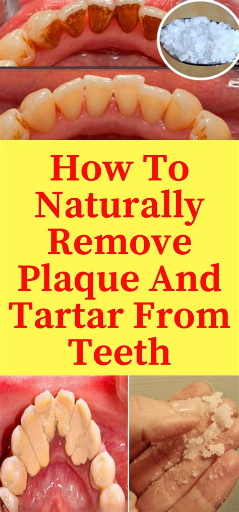 Daily Health Advisor : How To Naturally Remove Plaque And Tartar From Teeth