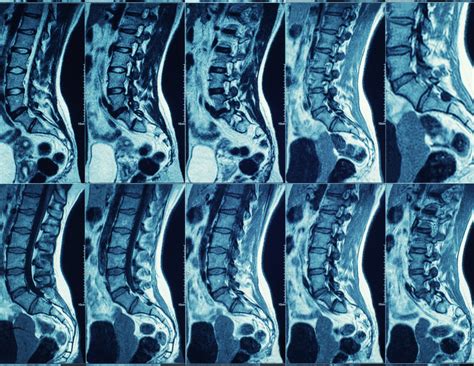 You Are Not Defined By Your MRI Results - PT Solutions