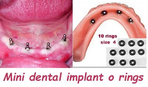 Mini dental implant o rings