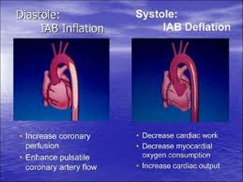 Intra Aortic Balloon Pump Heart