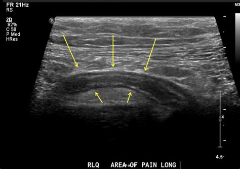 Appendicitis - Stepwards