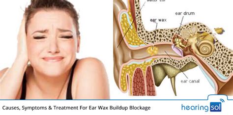 How To Get Wax Out Of Your Ear Canal