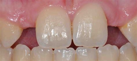 Resin Bonded Bridge for Lateral Incisor Replacement - Lee Ann Brady DMD