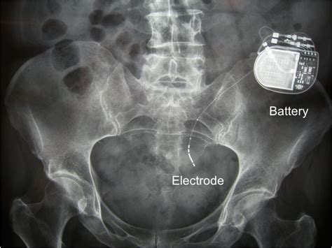 Faecal Incontinence: Treatment Options