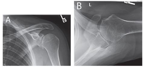 Glenohumeral Arthritis | Musculoskeletal Key