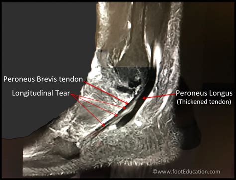 Peroneal Tendonitis - FootEducation