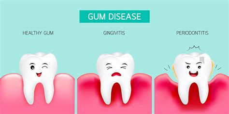 Gum or Periodontal Disease Causes, Symptoms, Diagnosis