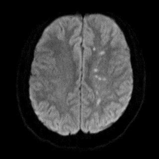 Magnetic resonance imaging showing multiple punctate infarcts in the ...