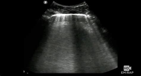 HD - POCUS for Pulmonary Edema | EM:RAP