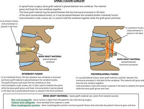 Spinal fusion illustration