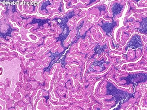 Webpathology.com: A Collection of Surgical Pathology Images