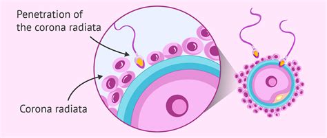 Penetration of the corona radiata