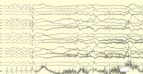 Nocturnal epilepsy diagnosis