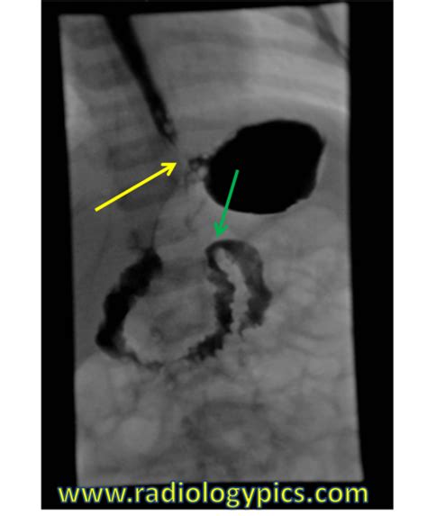 Normal Pediatric Upper GI | RADIOLOGYPICS.COM