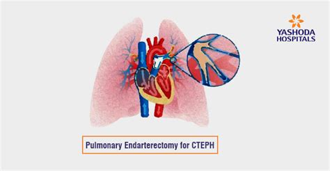 Pulmonary Endarterectomy: A Complex lifesaving lung surgery