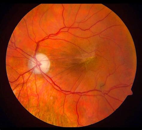 cellophane maculopathy | Ophthnotes | Intracranial pressure, Eye health ...