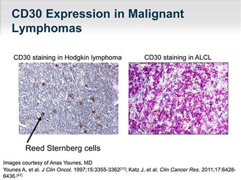 What You Need to Know About CD30 and Lymphoma (Transcript)