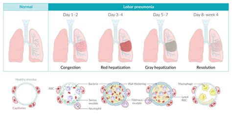 Pneumonia in young adults – Telegraph